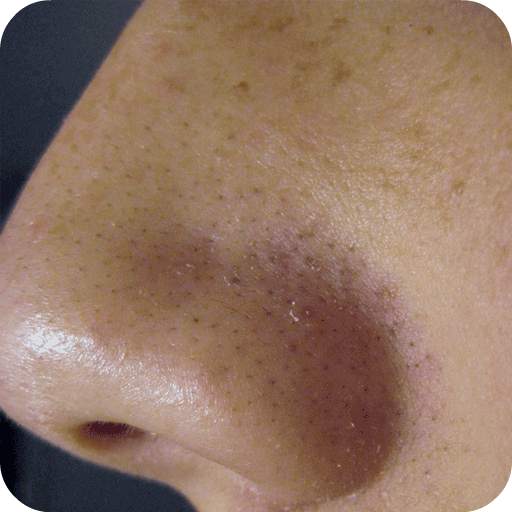 Remove Blackheads Home Remedy 1.3