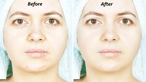 Pimple Eraser Photo Editor screenshot 5