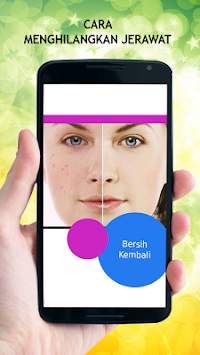 Cara Menghilangkan Jerawat screenshot 1