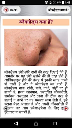 ब्लैक हेड्स हटाने के उपाय~How to Remove Blackheads screenshot 2