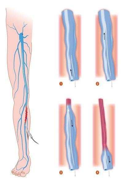 Sclerotherapy screenshot 1
