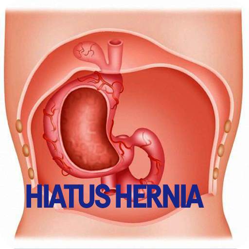 Hiatus Hernia Disease 1.0.0