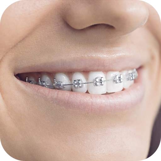 Teeth Braces Photo editor 1.6