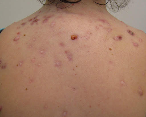 How To Get Rid of Pimples/Acne screenshot 2