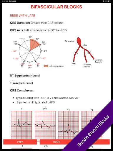 ECG FlashCards 2 Lite - Free Reference EKG App screenshot 4
