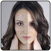 Acne Remover Zit remover Pimple Eraser 2.0