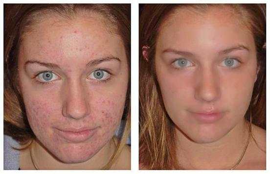 Pimple Remover screenshot 3