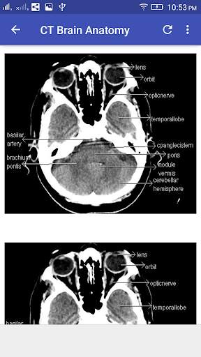 CT Brain Interpretation 2 تصوير الشاشة