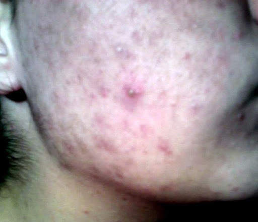 How To Get Rid of Pimples/Acne screenshot 1