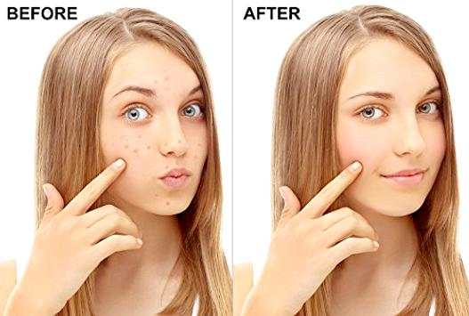 Pimple Remover screenshot 2