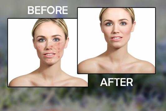 Pimple Remover-Pimple Eraser screenshot 4