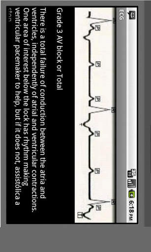 Electrocardiogram ECG Types screenshot 4