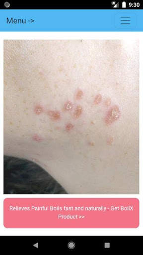 Boils Cure App Free - How to Prevent Boils screenshot 1