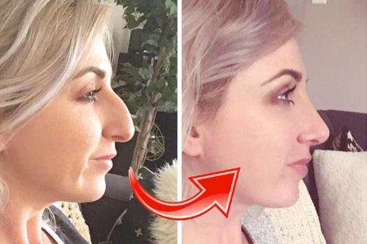 Nose Plastic Surgery 3 تصوير الشاشة
