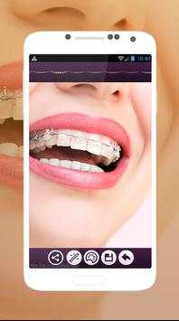 Braces Teeth Photo Editor screenshot 4