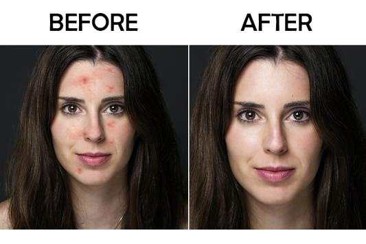 Pimple Remover-Pimple Eraser screenshot 2