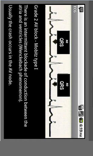 Electrocardiogram ECG Types screenshot 5