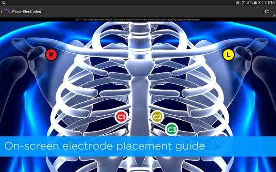 Alirus ECG screenshot 1
