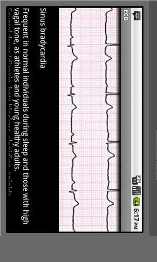 Electrocardiogram ECG Types screenshot 3