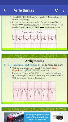 A to Z ECG Interpretation screenshot 4