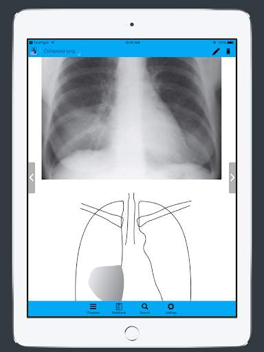 CXR FlashCards - Reference app for Chest X-rays screenshot 7