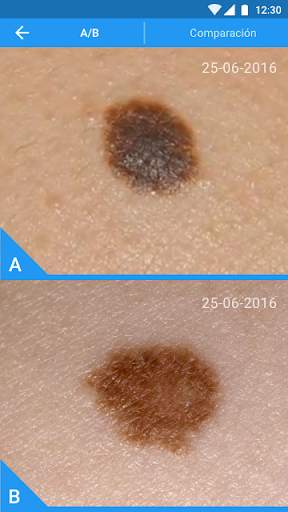 Molexplore - Melanoma & Skin Cancer App screenshot 5