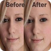 Photo Edit Blemishes - How to 1.0