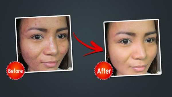 Object Remover -Erase Object -Face Blemish Remover screenshot 4