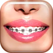 Braces