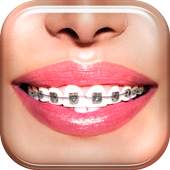 Braces 1.2.v7a