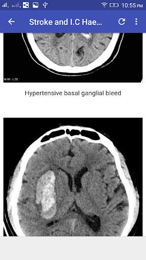 CT Brain Interpretation 8 تصوير الشاشة