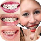 Fake Braces  Photo Editor 1.0