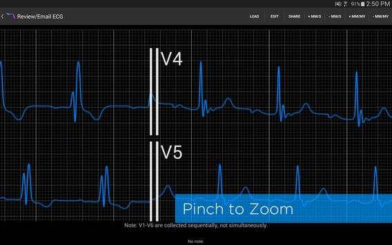 Alirus ECG screenshot 5