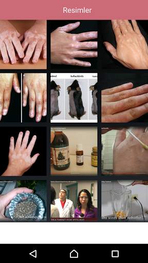 علاج البهاق 3 تصوير الشاشة