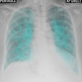 Chest X-Ray And Pathology icon