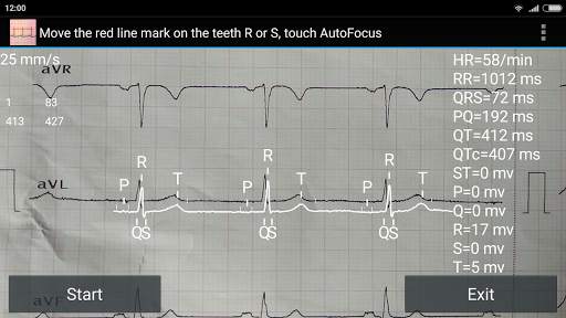 ECG Reader free screenshot 4