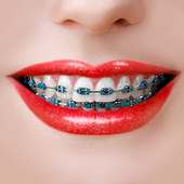 Behel Gigi - Braces Camera on 9Apps