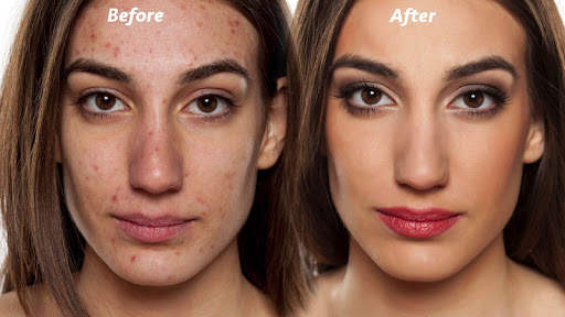 Pimple Eraser Photo Editor screenshot 2