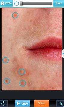 Blemish Remover screenshot 1