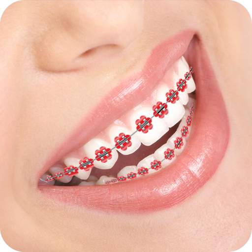 Braces Photo 2.1