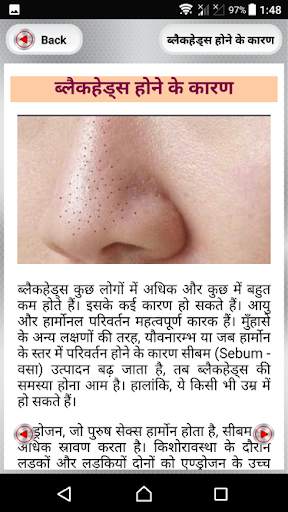 ब्लैक हेड्स हटाने के उपाय~How to Remove Blackheads screenshot 3