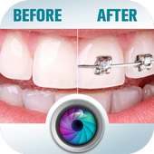 Before and After braces Photo logo