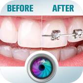 Before and After braces Photo 1.1